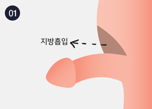 치골지방흡입술 이미지